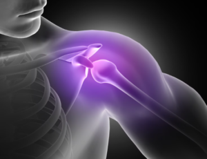 Frozen Shoulder: Causes and Treatment